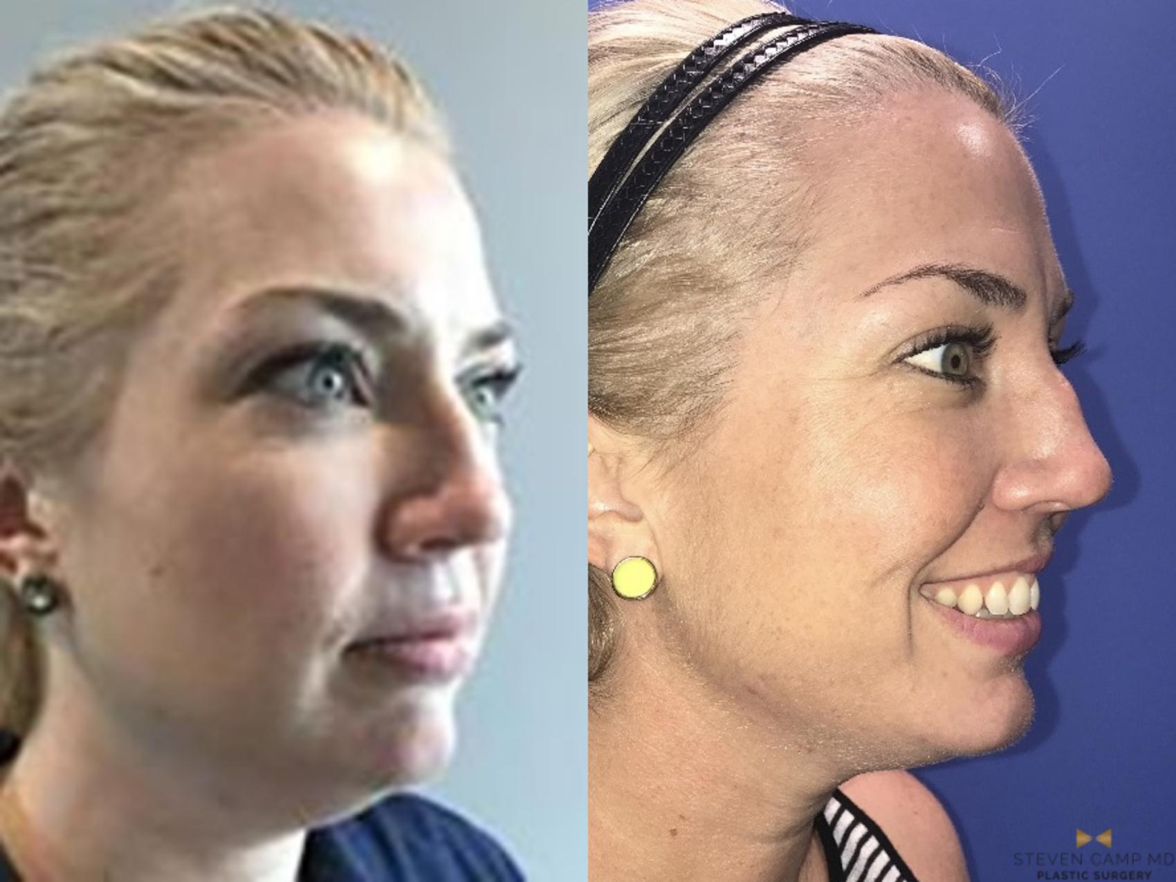 Before & After KYBELLA Case 82 View #2 View in Fort Worth, Texas