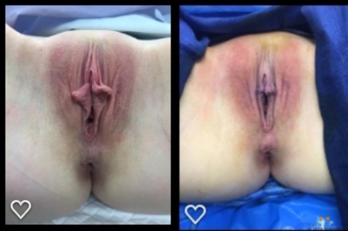 Before & After Labiaplasty Case 413 Front View in Fort Worth & Arlington, Texas