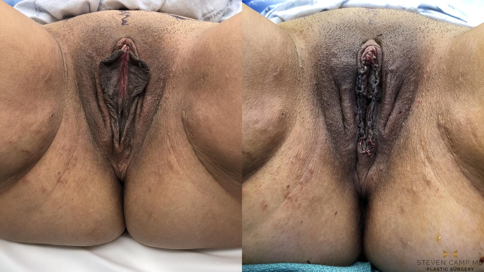Before & After Labiaplasty Case 414 Front View in Fort Worth, Texas