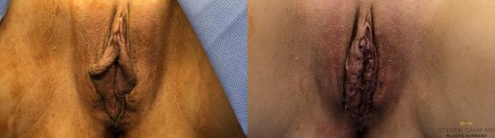 Before & After Labiaplasty Case 415 Front View in Fort Worth & Arlington, Texas