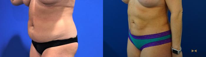 Before & After Liposuction Case 126 View #2 View in Fort Worth & Arlington, Texas