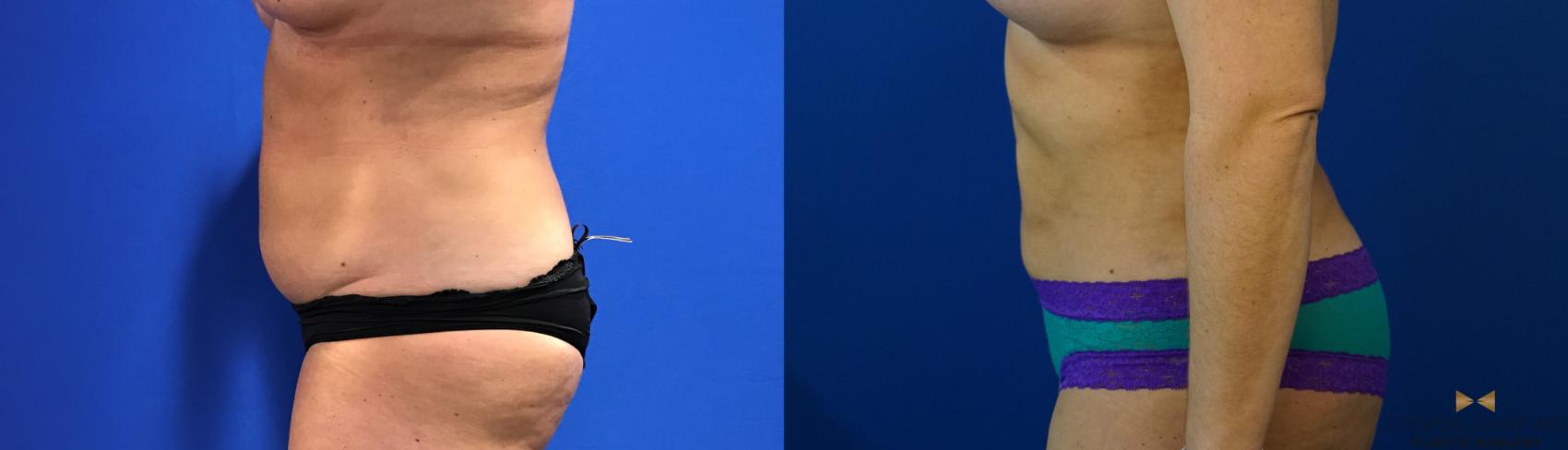 Before & After Liposuction Case 126 View #3 View in Fort Worth & Arlington, Texas