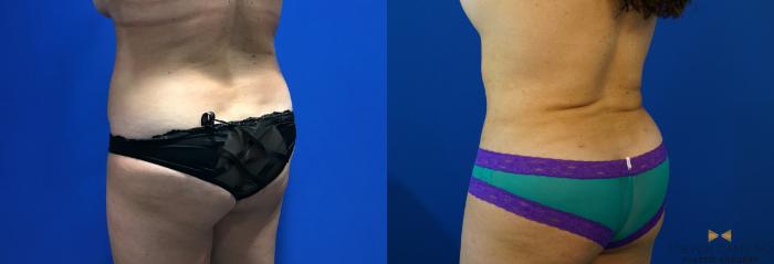 Before & After Liposuction Case 126 View #4 View in Fort Worth & Arlington, Texas