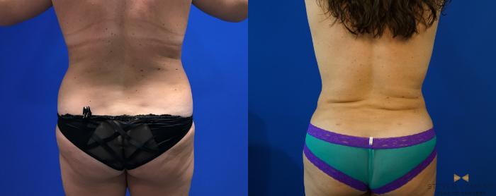 Before & After Liposuction Case 126 View #5 View in Fort Worth & Arlington, Texas
