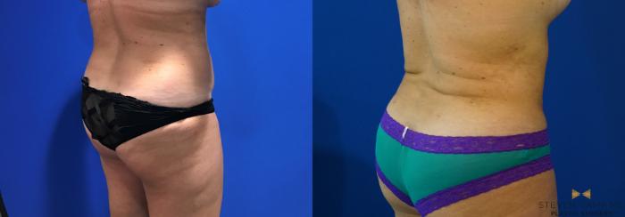 Before & After Liposuction Case 126 View #6 View in Fort Worth & Arlington, Texas