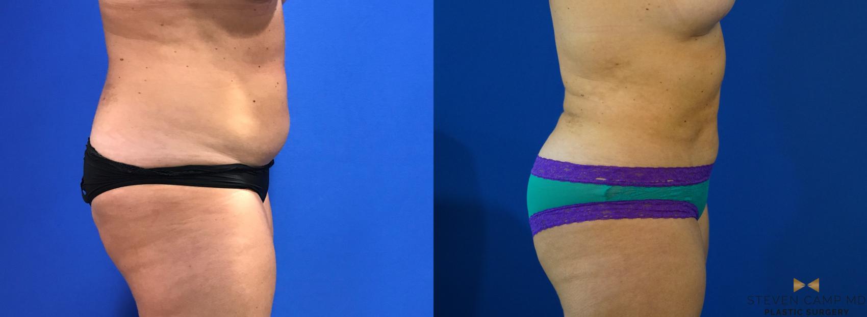 Before & After Liposuction Case 126 View #7 View in Fort Worth & Arlington, Texas