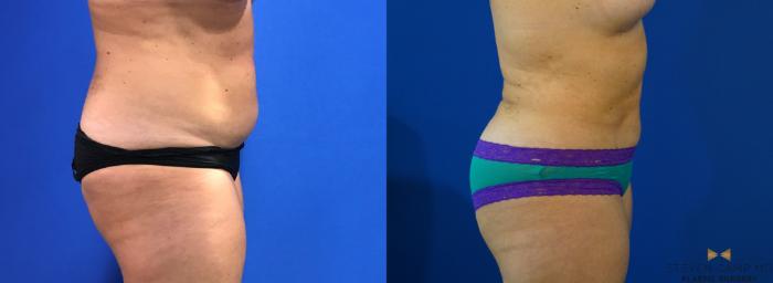 Before & After Liposuction Case 126 View #7 View in Fort Worth & Arlington, Texas