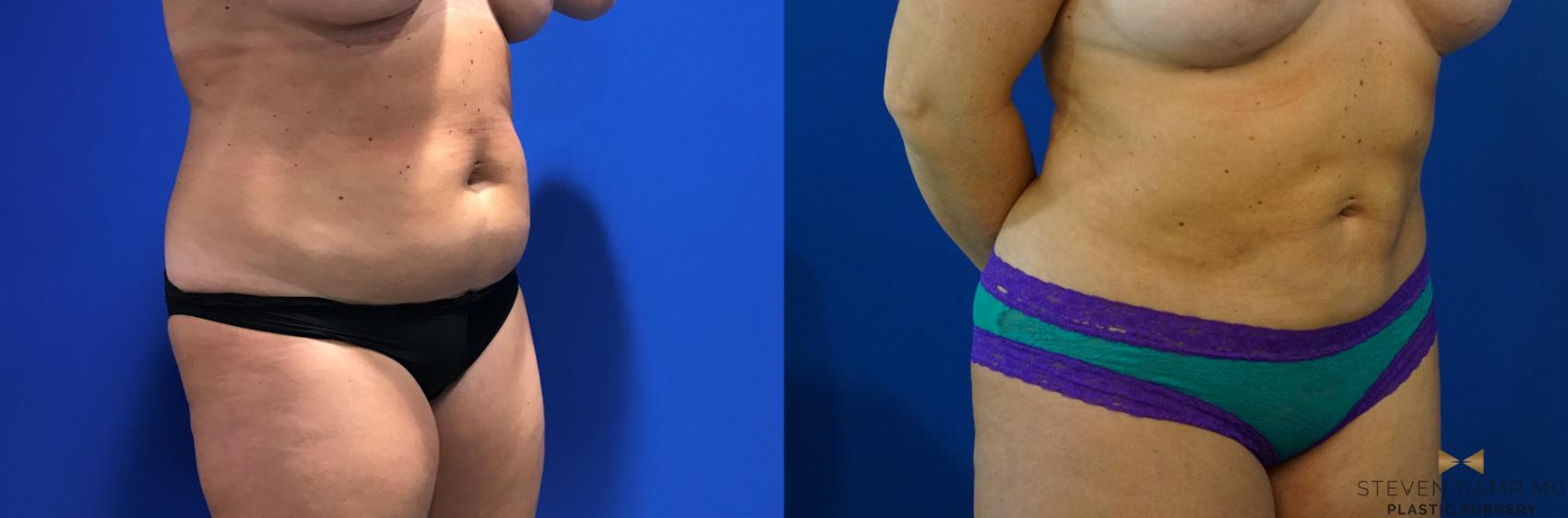 Before & After Liposuction Case 126 View #8 View in Fort Worth & Arlington, Texas
