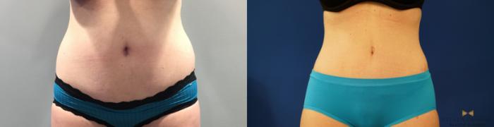 Before & After Liposuction Case 144 View #1 View in Fort Worth & Arlington, Texas
