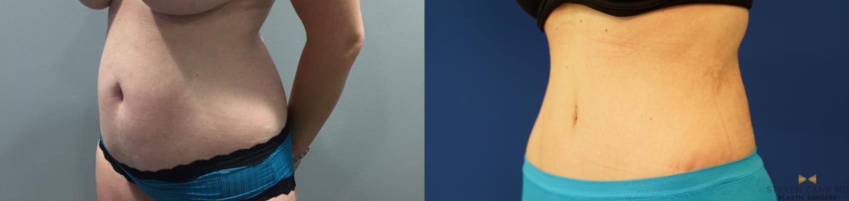 Before & After Liposuction Case 144 View #2 View in Fort Worth & Arlington, Texas