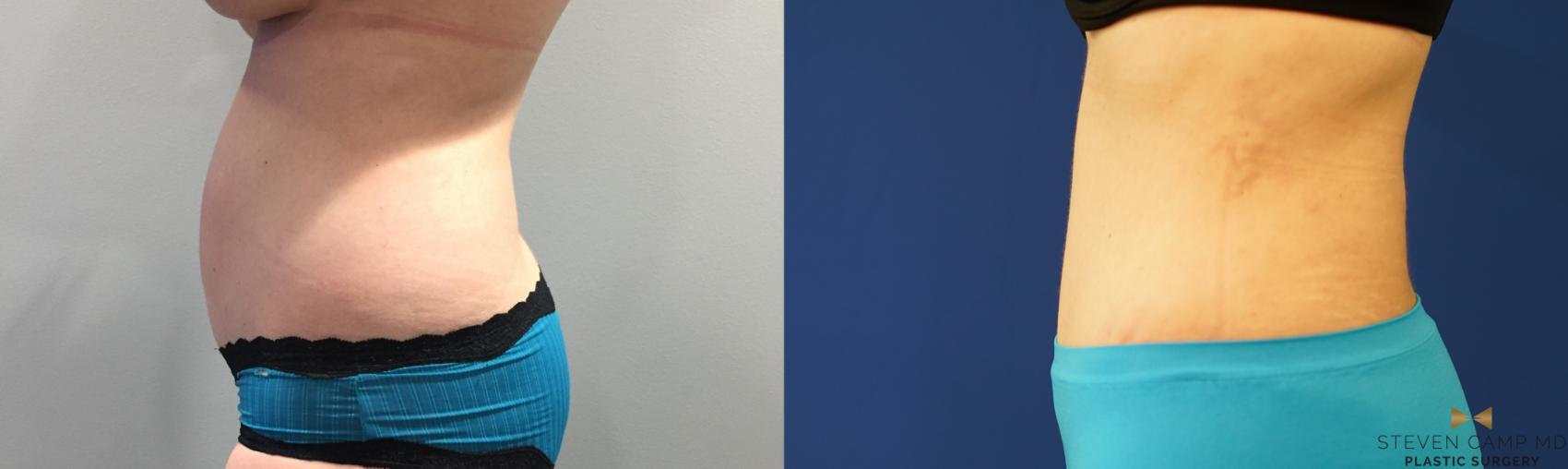 Before & After Liposuction Case 144 View #3 View in Fort Worth & Arlington, Texas