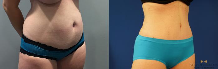 Before & After Liposuction Case 144 View #4 View in Fort Worth & Arlington, Texas