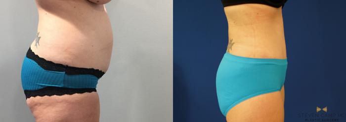 Before & After Liposuction Case 144 View #5 View in Fort Worth & Arlington, Texas