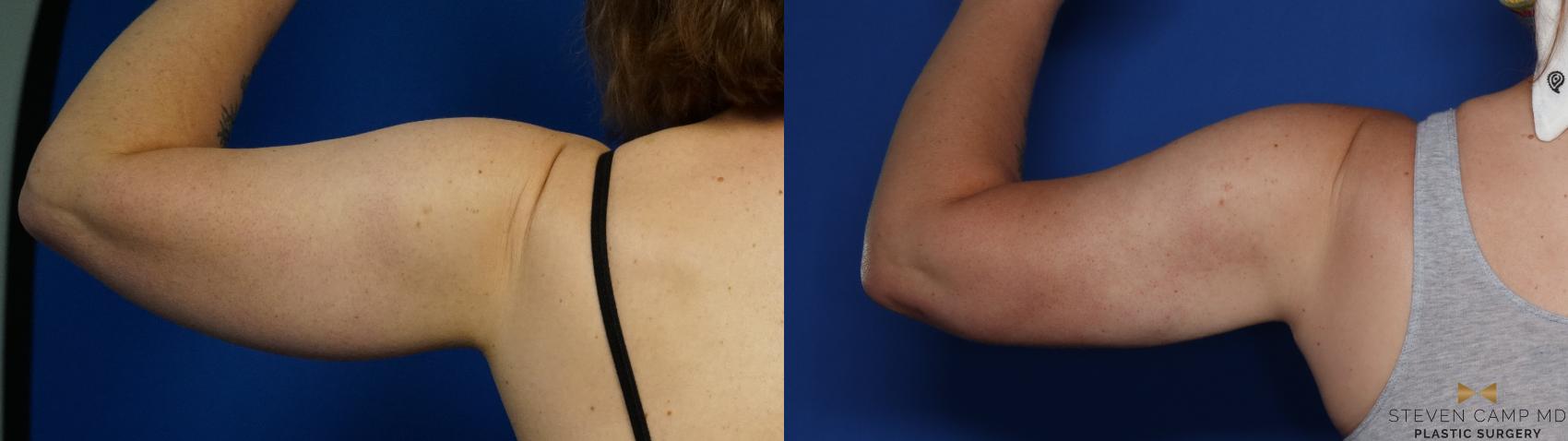 Before & After Liposuction Case 412 Back View in Fort Worth & Arlington, Texas