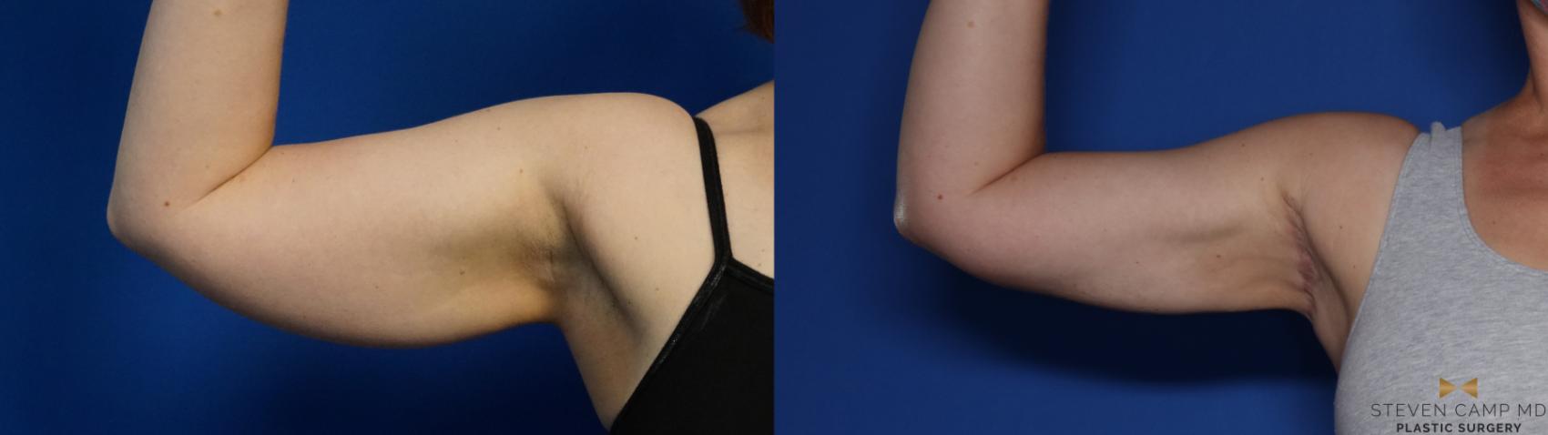 Before & After Liposuction Case 412 Right Oblique View in Fort Worth & Arlington, Texas