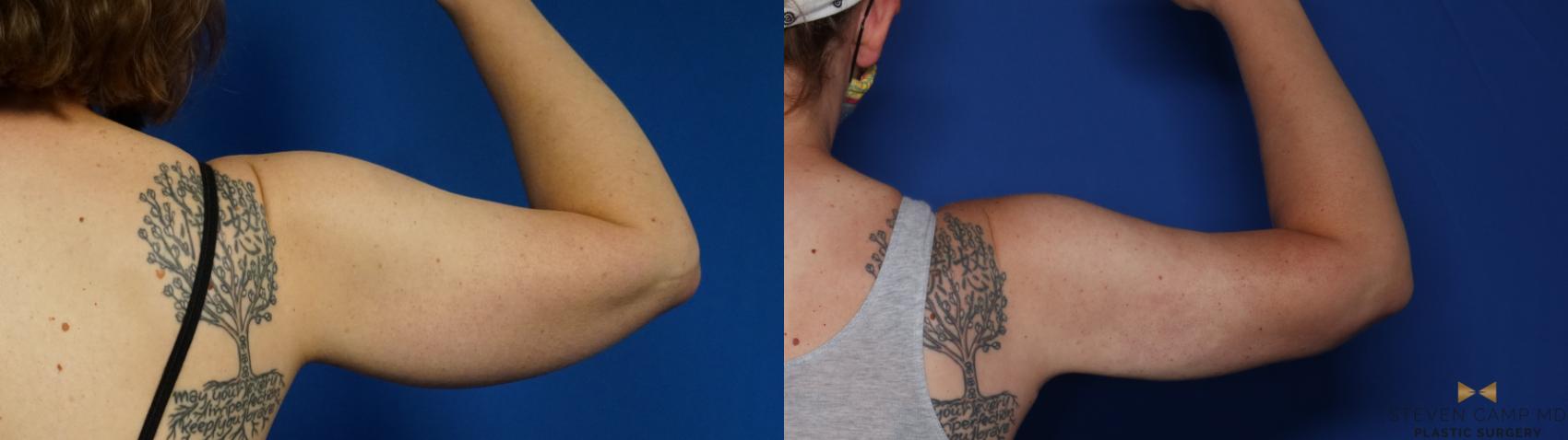 Before & After Liposuction Case 412 Right Side View in Fort Worth & Arlington, Texas