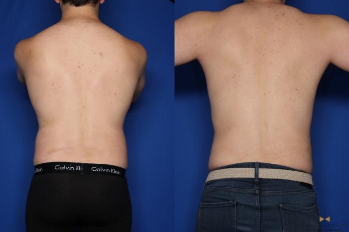 Before & After Liposuction Case 421 Back View in Fort Worth, Texas