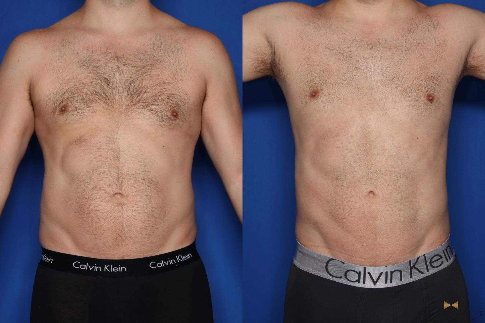 Before & After Liposuction Case 421 Front View in Fort Worth & Arlington, Texas