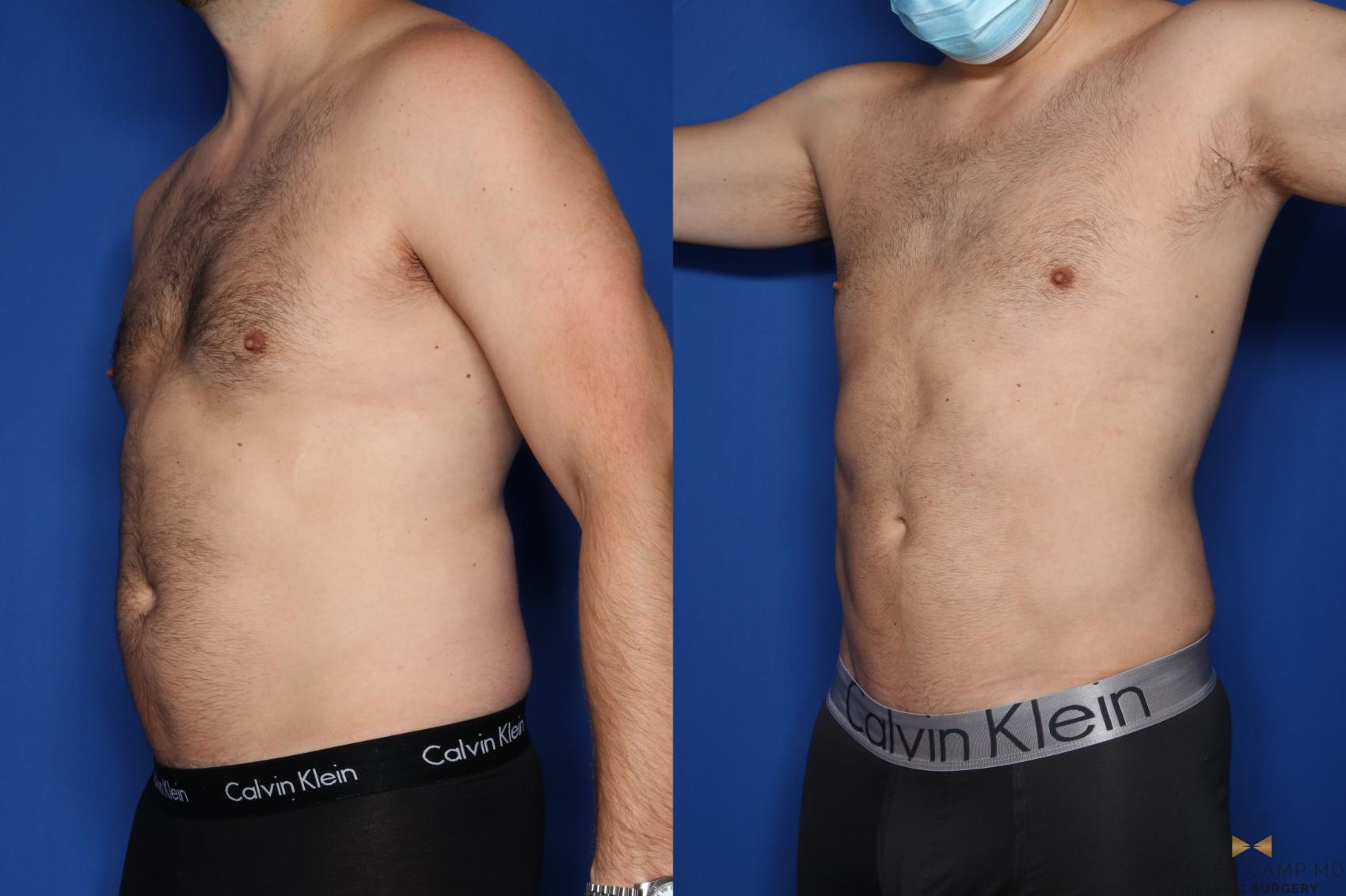 Before & After Liposuction Case 421 Left Oblique View in Fort Worth & Arlington, Texas