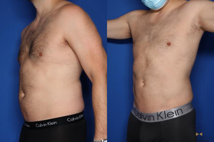 Liposuction Before and After Pictures Case 101, Gilbert, AZ