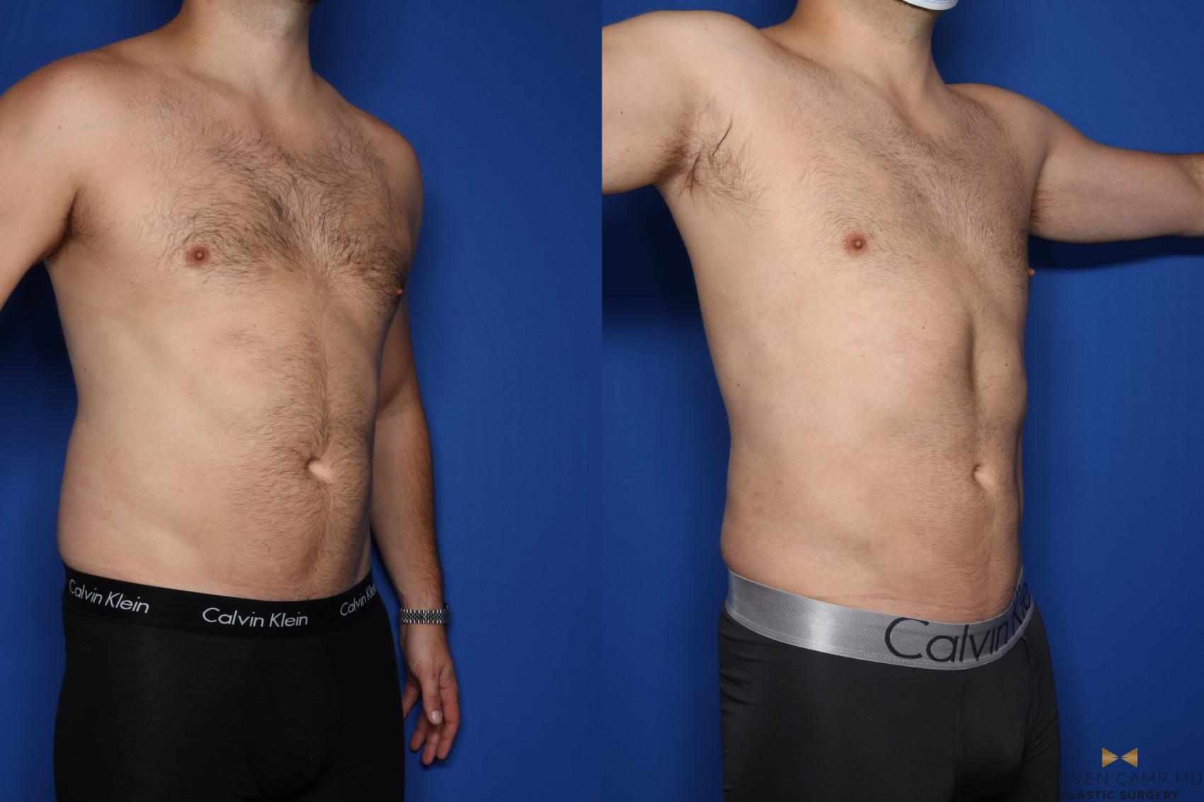 Before & After Liposuction Case 421 Right Oblique View in Fort Worth & Arlington, Texas