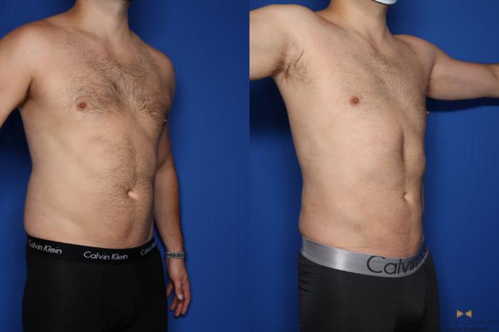 Before & After Liposuction Case 421 Right Oblique View in Fort Worth, Texas