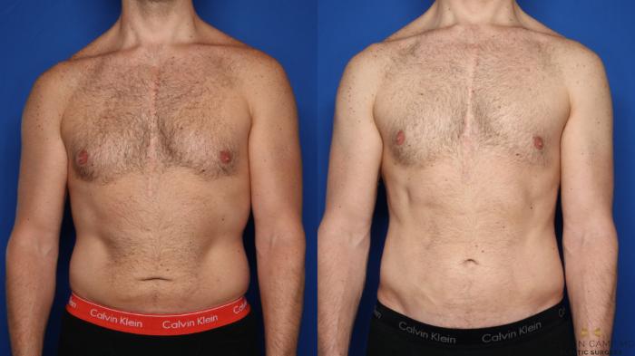 Before & After Liposuction Case 456 Front View in Fort Worth & Arlington, Texas
