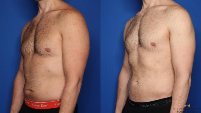 Before & After Liposuction Case 456 Left Oblique View in Fort Worth & Arlington, Texas
