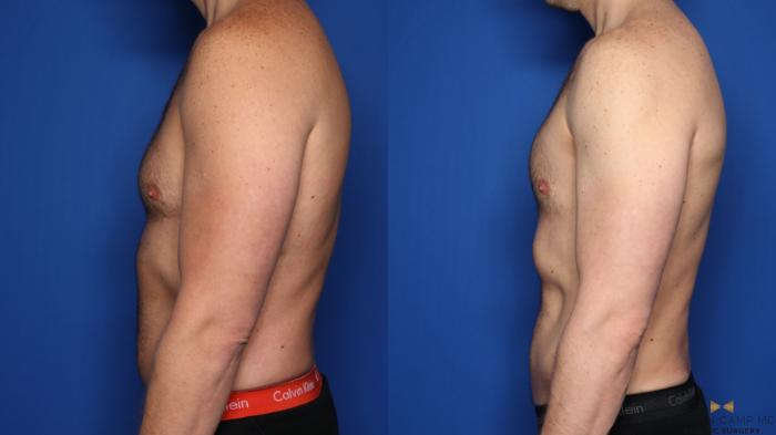 Before & After Liposuction Case 456 Left Side View in Fort Worth & Arlington, Texas