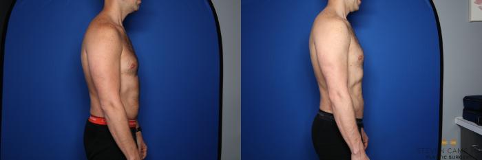 Before & After Liposuction Case 456 Right Side View in Fort Worth & Arlington, Texas