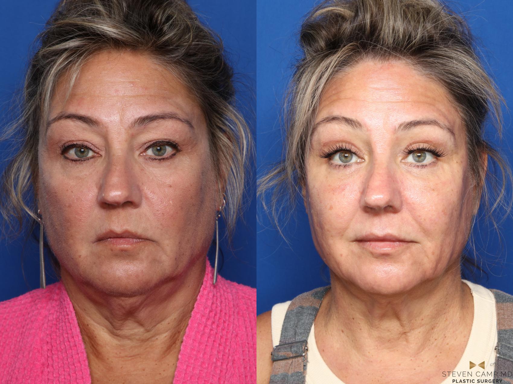 Before & After Liposuction Case 545 Front View in Fort Worth & Arlington, Texas