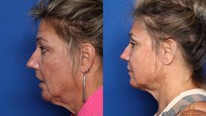 Before & After Liposuction Case 545 Left Side View in Fort Worth & Arlington, Texas