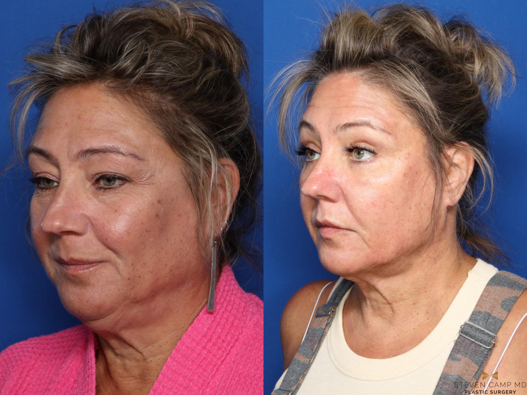 Before & After Liposuction Case 545 Right Oblique View in Fort Worth & Arlington, Texas