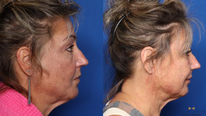 Before & After Liposuction Case 545 Right Side View in Fort Worth & Arlington, Texas
