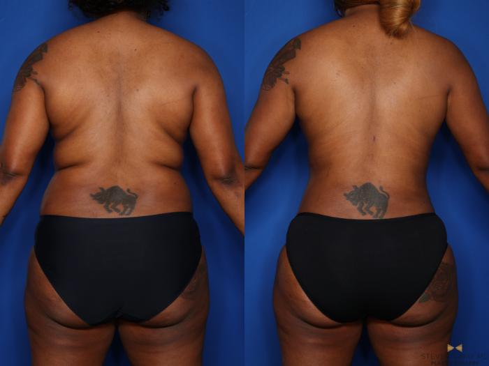Before & After Tummy Tuck Case 576 Back View in Fort Worth & Arlington, Texas