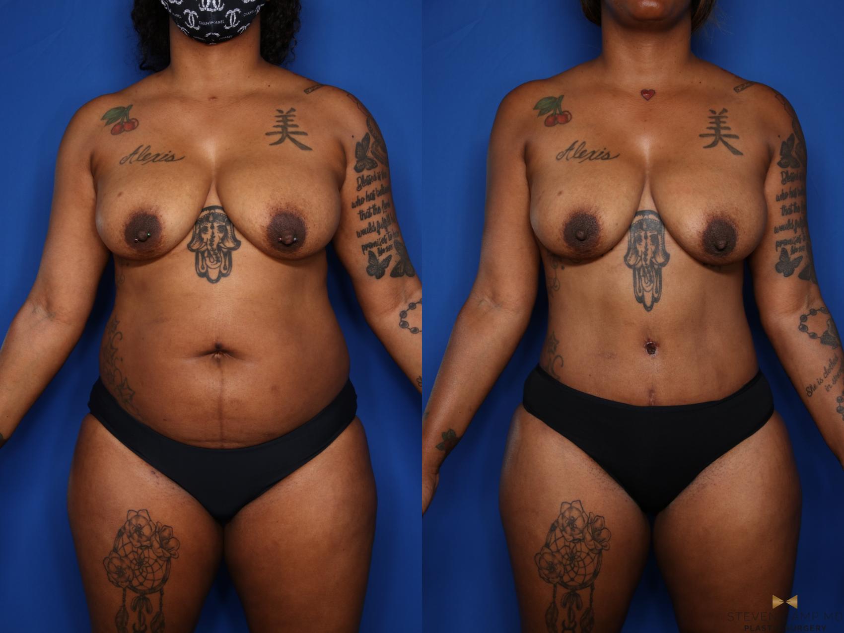 Before & After Liposuction Case 576 Front View in Fort Worth & Arlington, Texas