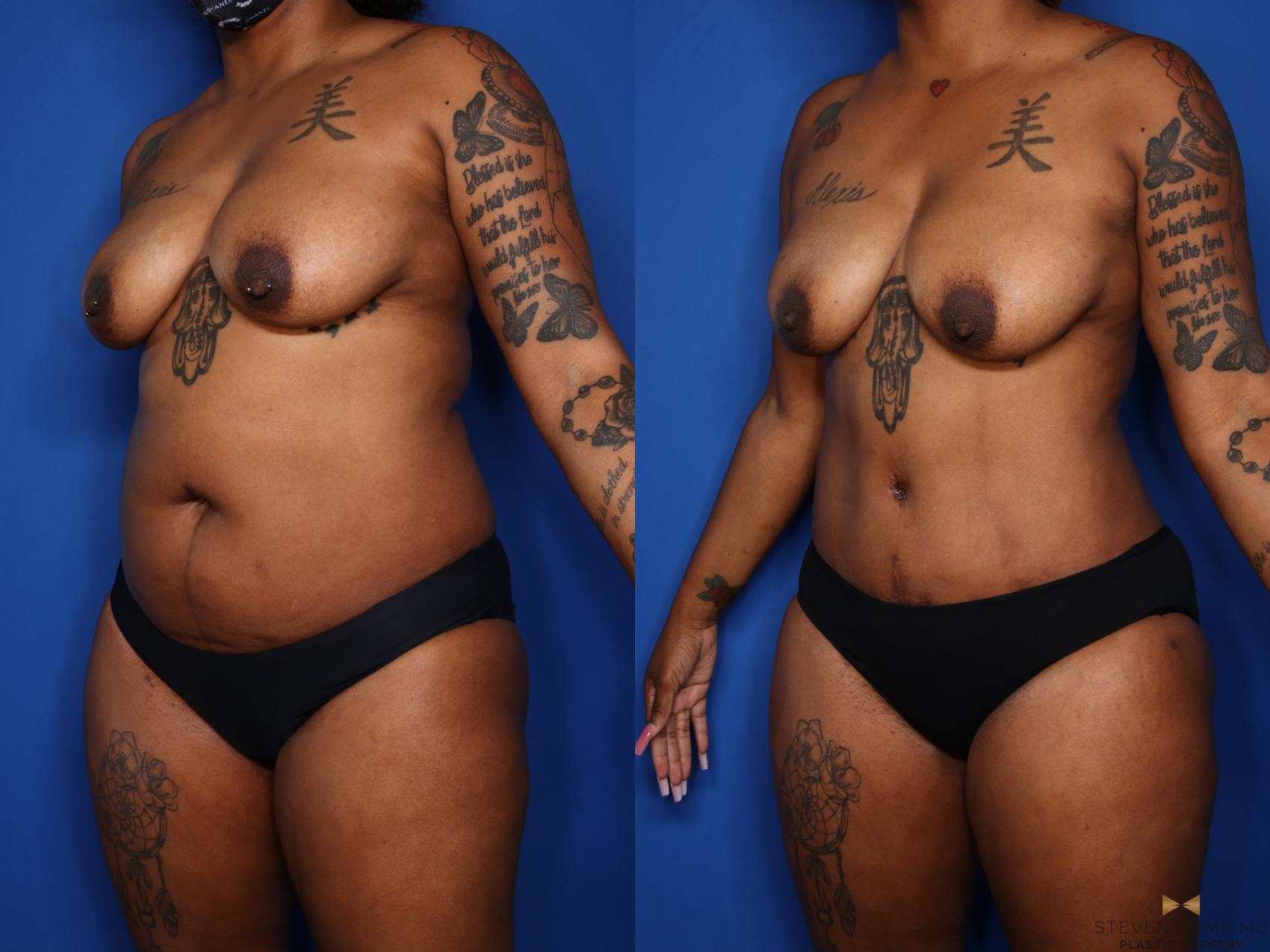 Before & After Liposuction Case 576 Left Oblique View in Fort Worth & Arlington, Texas