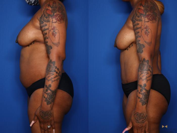 Before & After Liposuction Case 576 Left Side View in Fort Worth, Texas