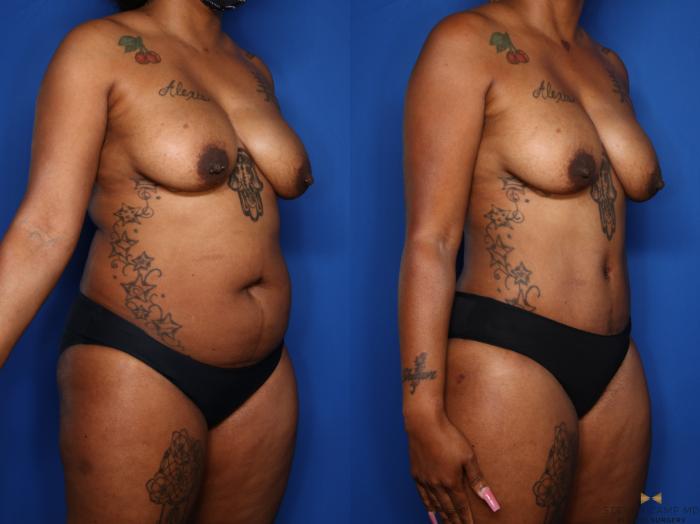 Before & After Tummy Tuck Case 576 Right Oblique View in Fort Worth & Arlington, Texas