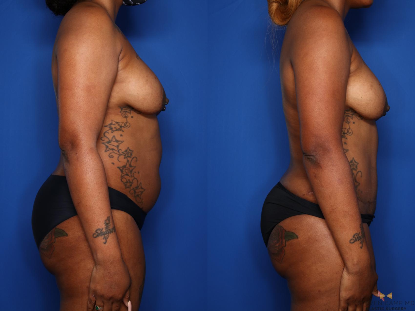 Before & After Liposuction Case 576 Right Side View in Fort Worth & Arlington, Texas