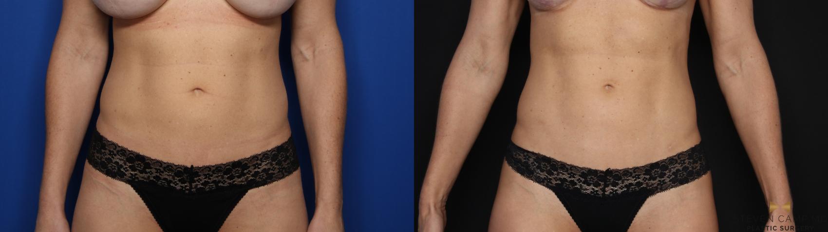 Before & After Liposuction Case 581 Front View in Fort Worth, Texas