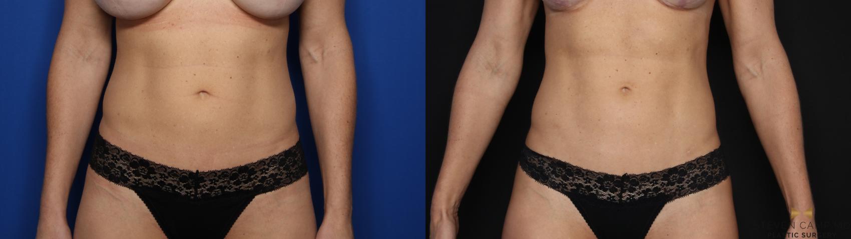 Before & After Liposuction Case 581 Front View in Fort Worth & Arlington, Texas