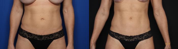 Before & After Liposuction Case 581 Front View in Fort Worth & Arlington, Texas