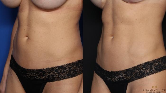 Before & After Liposuction Case 581 Left Oblique View in Fort Worth & Arlington, Texas