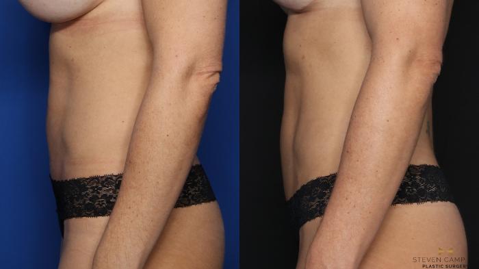 Before & After Liposuction Case 581 Left Side View in Fort Worth & Arlington, Texas