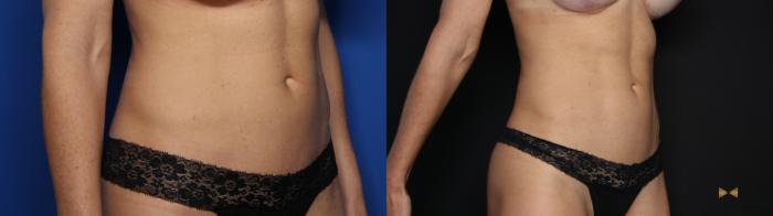 Before & After Liposuction Case 581 Right Oblique View in Fort Worth & Arlington, Texas