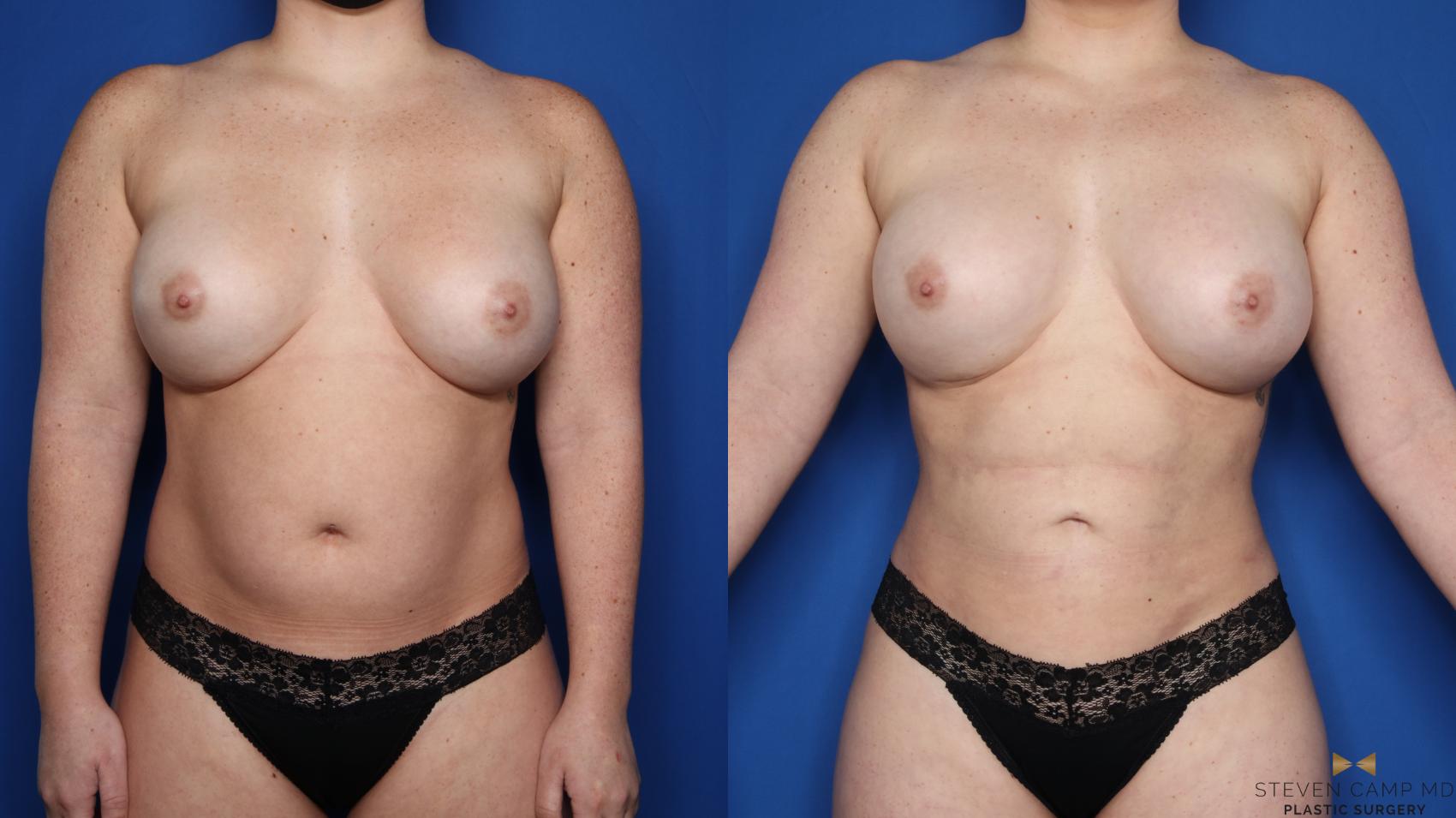 Before & After Liposuction Case 585 Front View in Fort Worth & Arlington, Texas