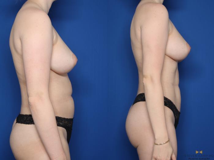 Before & After Liposuction Case 619 Left Side View in Fort Worth & Arlington, Texas