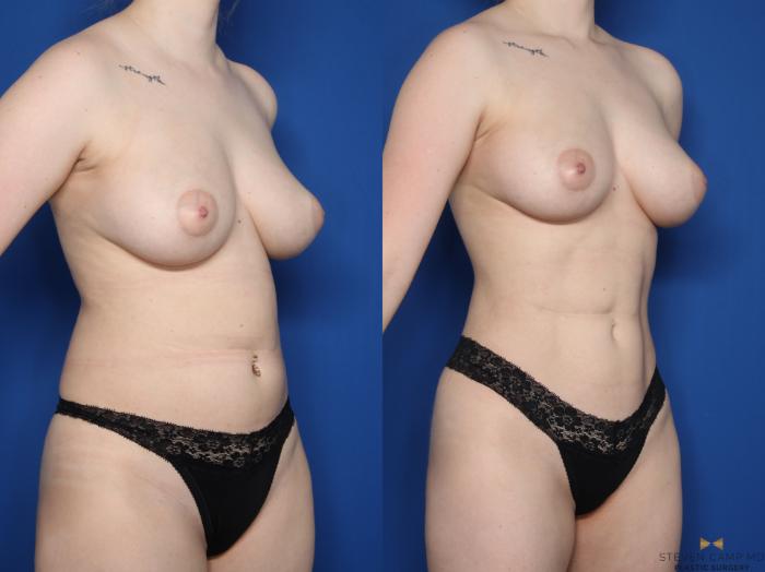 Before & After Renuvion Skin Tightening Case 619 Right Oblique View in Fort Worth & Arlington, Texas