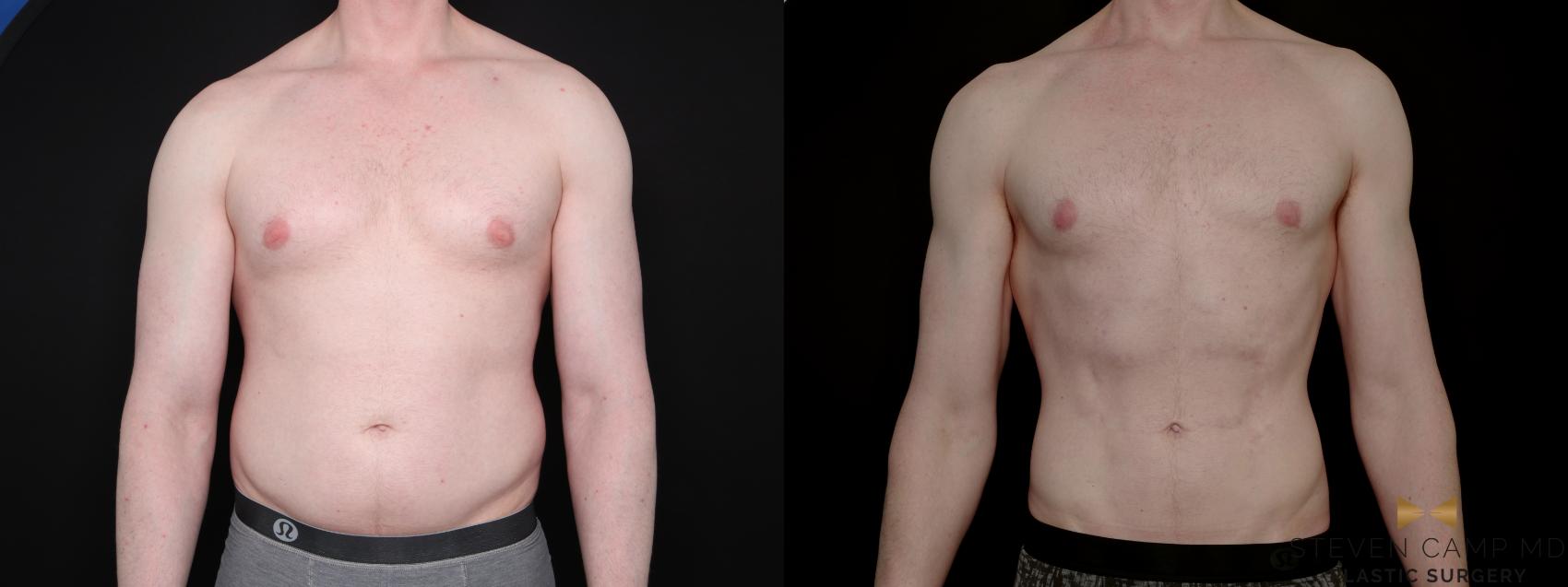 Before & After Liposuction Case 790 Front View in Fort Worth & Arlington, Texas